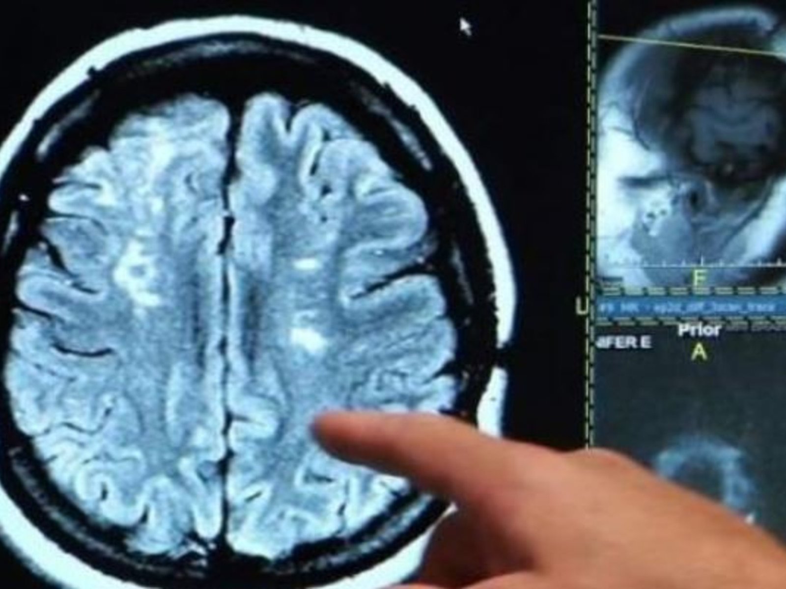 La ciencia descubrió la clave dentro del cerebro que diferencia a las personas optimistas de las pesimistas
