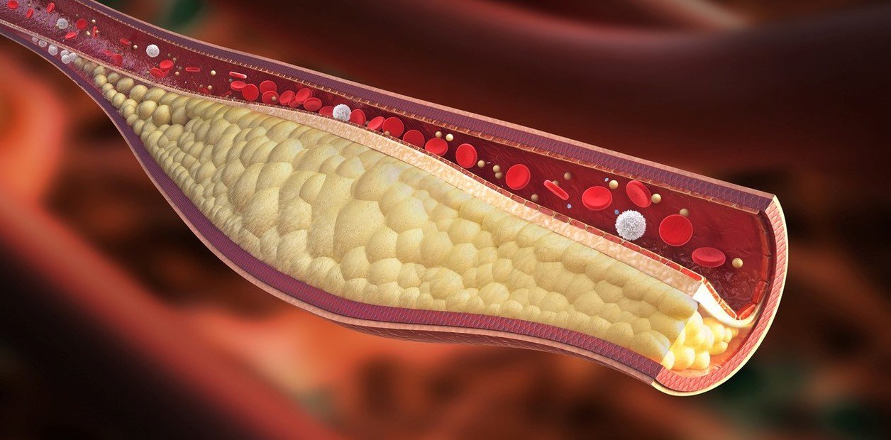 hallan una molécula en el intestino que puede cambiar la forma de tratar la ateroesclerosis