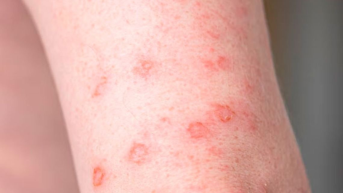 Córdoba encabeza casos de sífilis: experto advierte sobre política estatal fallida en prevención