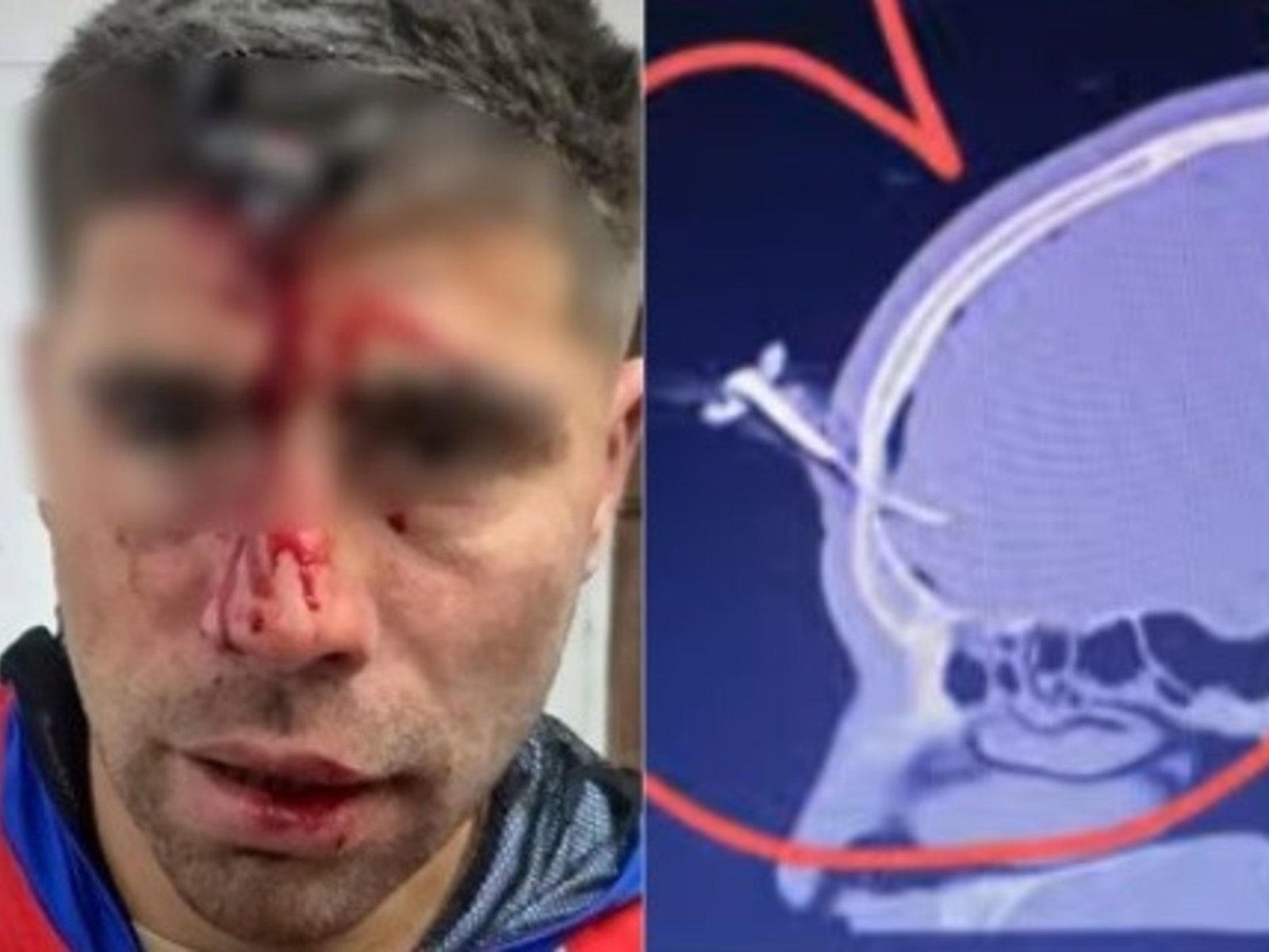 Le clavaron una llave en la cabeza a un jugador del Ascenso durante una salvaje pelea en un torneo de fútbol femenino