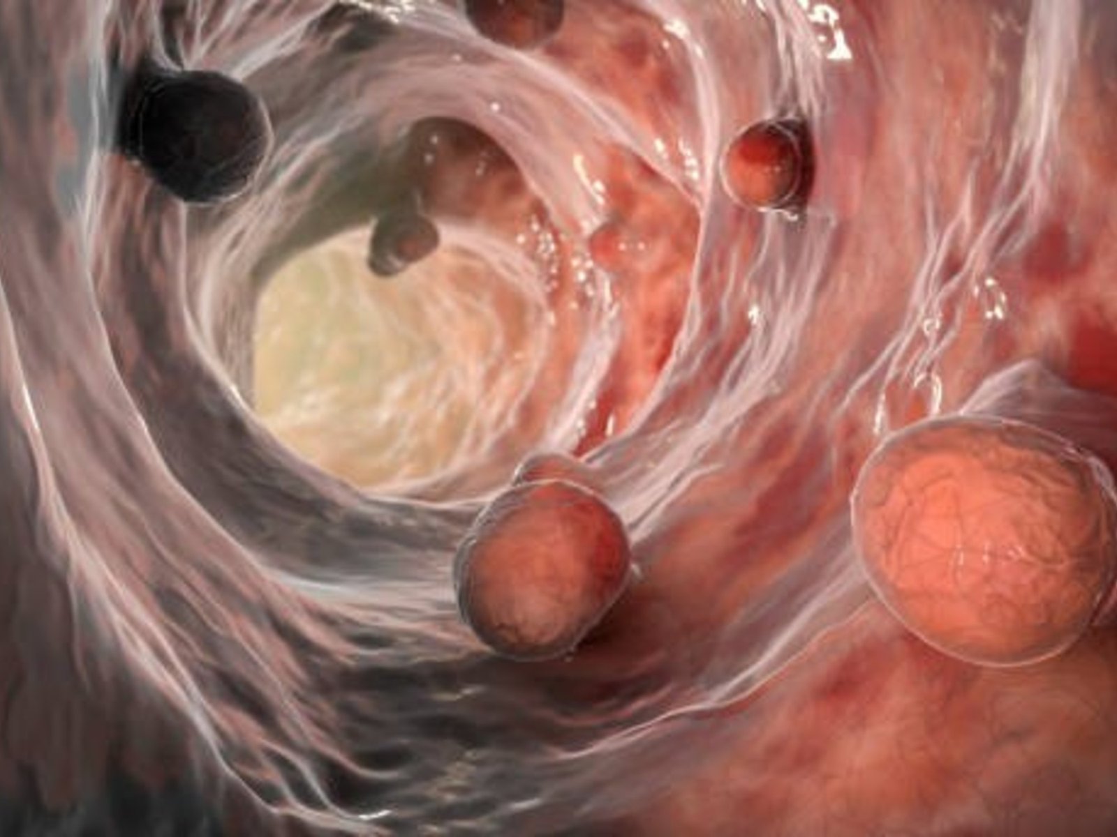 Harán un test muy sencillo en puestos callejeros para prevenir el segundo cáncer más frecuente