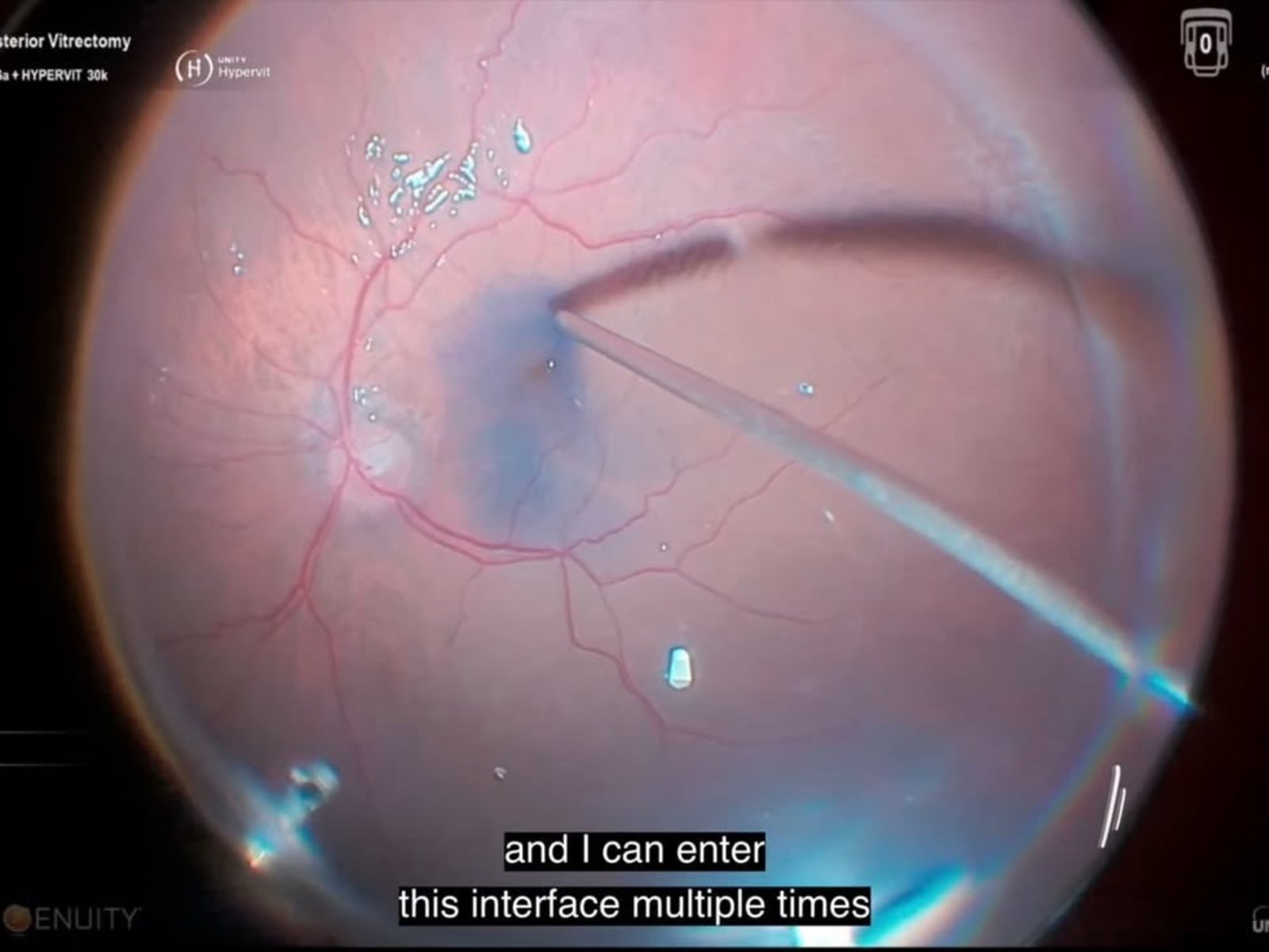 Crearon una solución simple para una de las cirugías del ojo más riesgosas y ganaron su séptimo "Óscar de la retina"